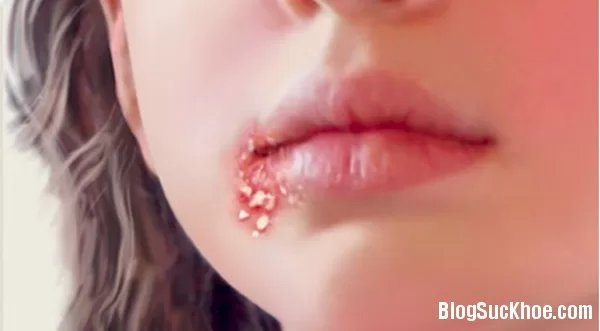 Mắc bệnh lây truyền đường tình dục không do quan hệ