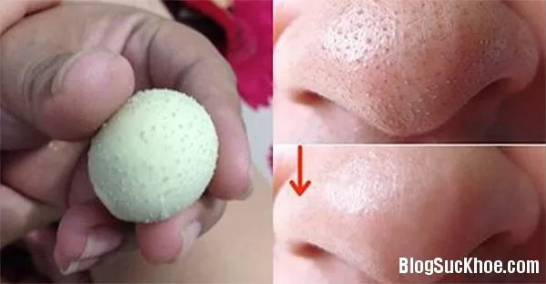 Bí quyết loại bỏ và phòng ngừa mụn đầu đen