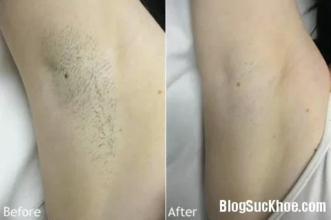 Mẹo làm sạch lông nách không cần nhổ