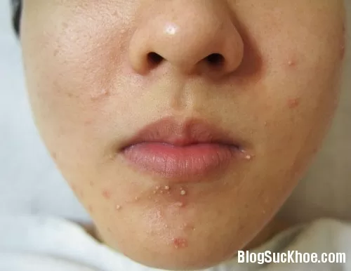 Phương pháp chăm sóc cho da bị mụn trứng cá