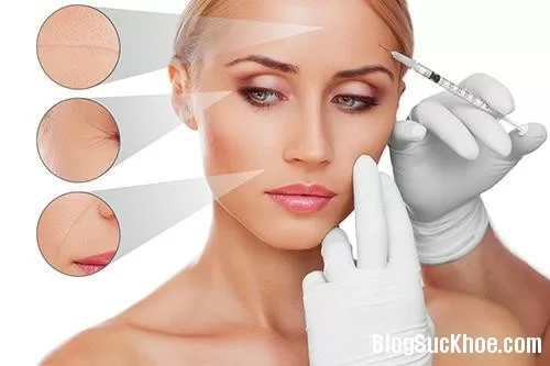 Tiêm filler và những điều cần lưu ý