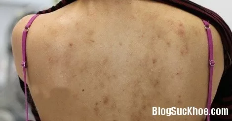 Cách chữa sạch mụn ở lưng