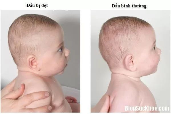 Nguyên nhân và cách khắc phục chứng móp đầu ở trẻ
