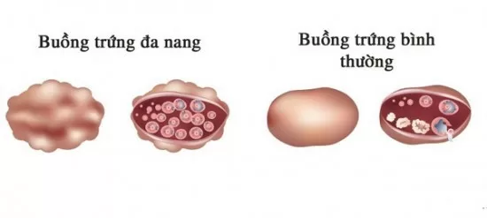 Hội chứng buồng trứng đa nang và những điều chị em cần biết