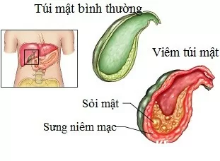 Nguyên nhân gây viêm túi mật