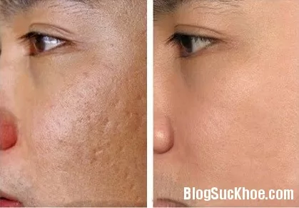 Tuyệt chiêu trị sẹo lõm từ nước ép đu đủ xanh và mật ong