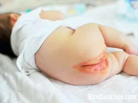 Những bệnh bé dễ mắc khi mặc bỉm quá lâu