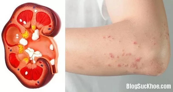 Những dấu hiệu cảnh báo thận bị hỏng cần khám gấp