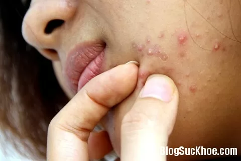 Công thức điều trị mụn trứng cá tại nhà