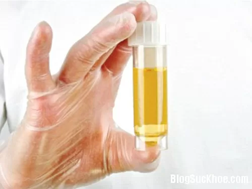 Nhìn màu nước tiểu đoán bệnh