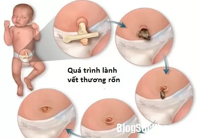 Chăm sóc rốn cho trẻ sơ sinh như thế nào?