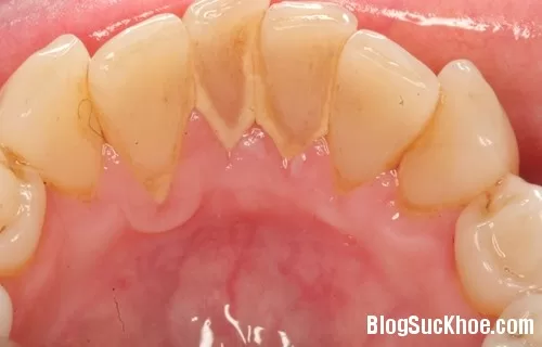 Lấy sạch cao răng không hề tốn kém