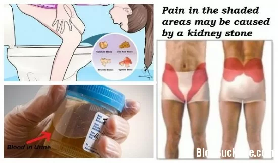 Nguyên nhân và các yếu tố nguy cơ dẫn đến ung thư hậu môn