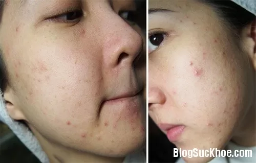 Cách trị mụn bọc bằng nghệ tươi và chanh