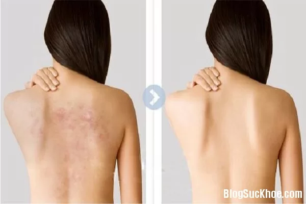 Sạch mụn ở lưng nhờ mật ong