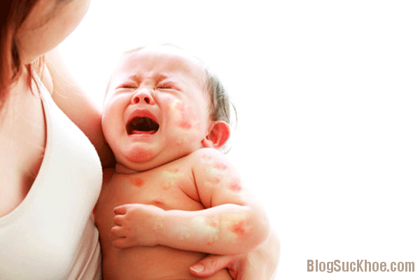 Cách chăm sóc khi trẻ bị dị ứng sữa bò