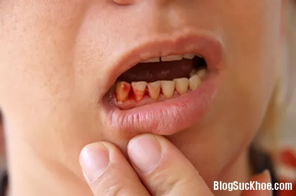 Cách trị chảy máu chân răng hiệu quả nhất