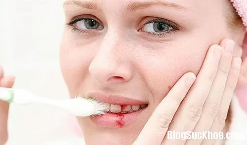 Chảy máu chân răng - nguy cơ đối mặt với bệnh nguy hiểm