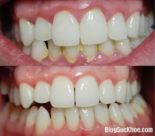 Lấy cao răng tại nhà chỉ với 2 phút sử dụng muối