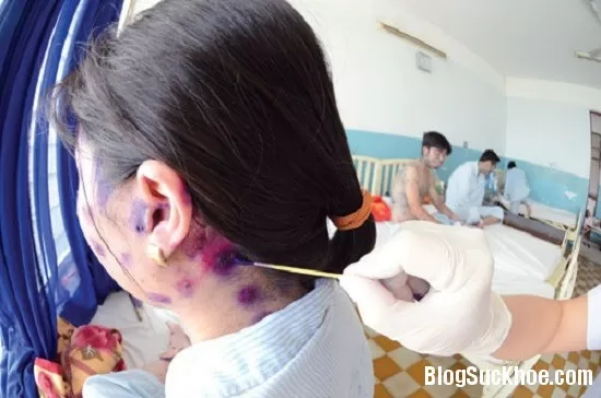 Những điều cần biết về bệnh thủy đậu