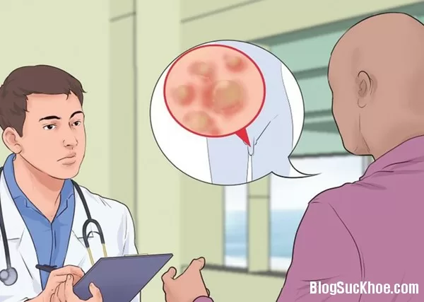 Điều trị bệnh sùi mào gà bằng thuốc bôi