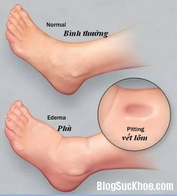 Nguyên nhân và triệu chứng bệnh phù