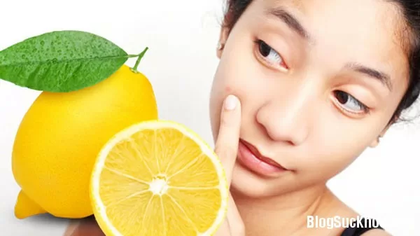 Sạch thâm mụn và sẹo nhờ dùng chanh đúng cách