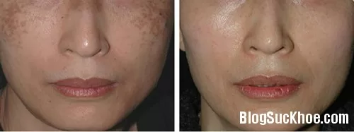 Mẹo hay xóa mờ tàn nhang, đẩy tone da lên sáng hồng