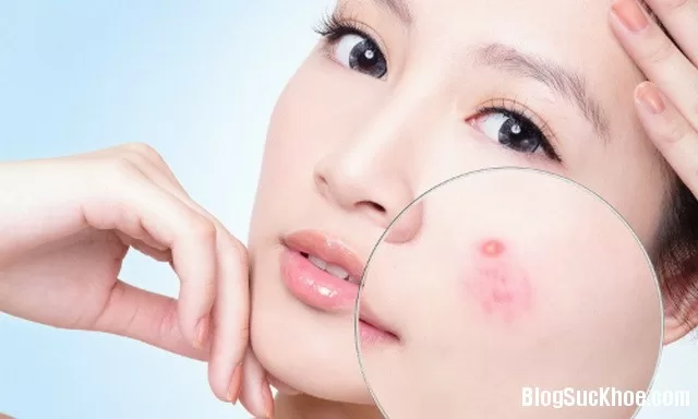 Mẹo trị mụn ẩn dưới da tại nhà