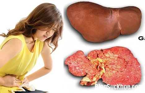 Triệu chứng mắc ung thư gan giai đoạn đầu