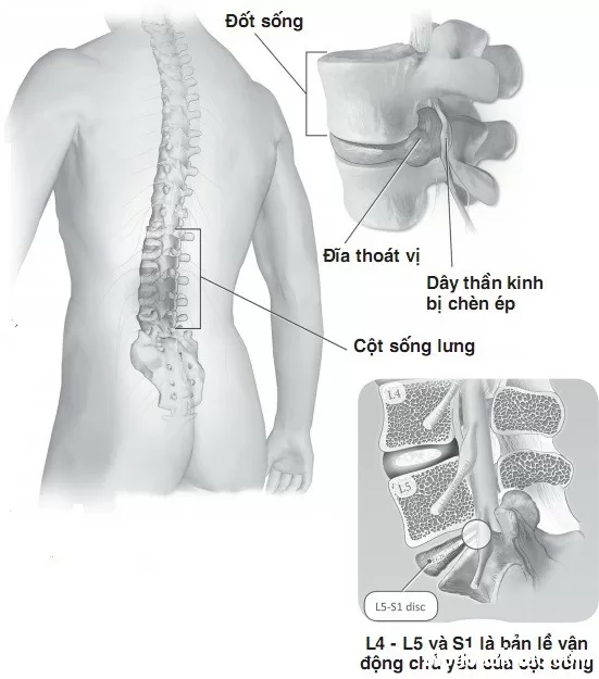 Thoát vị đĩa đệm cột sống thắt lưng