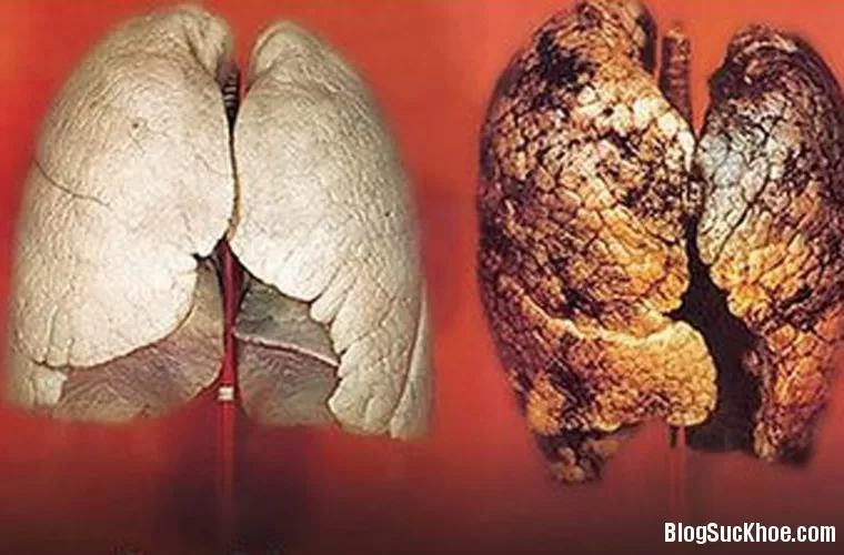 "Thanh lọc" phổi nám đen vì thuốc lá