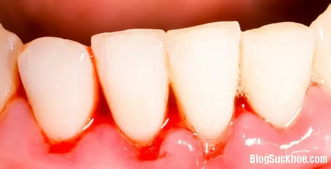 Chảy máu chân răng và cách phòng ngừa