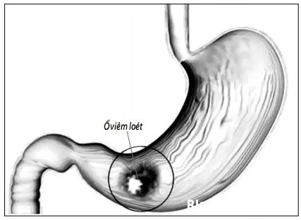 Các nhóm thuốc trị viêm loét dạ dày - tá tràng