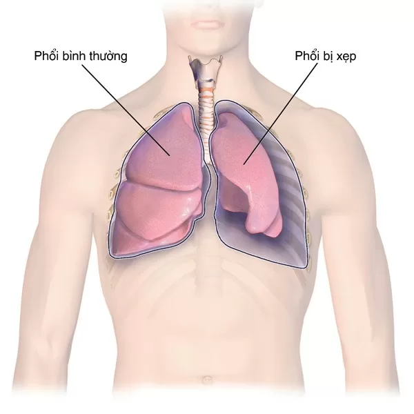 Triệu chứng và biến chứng tràn khí màng phổi