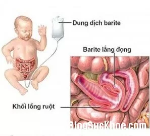 Biểu hiện đau bụng cấp ở trẻ em