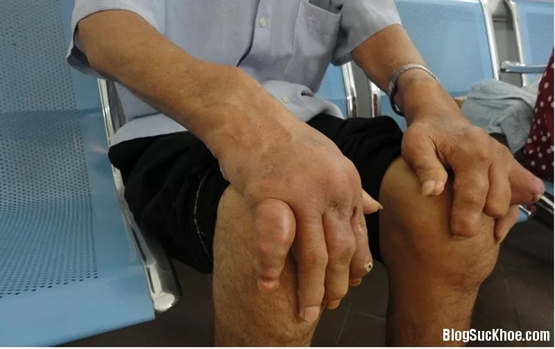 Lời khuyên dinh dưỡng cho bệnh nhân mắc bệnh gút