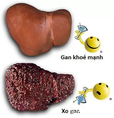 Những dấu hiệu gan nhiễm mỡ thường bị bỏ qua