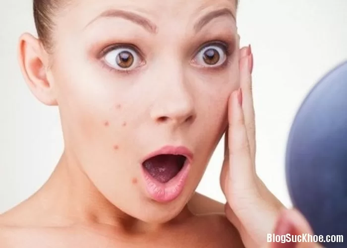 Bí quyết giúp mẹ bầu trị sạch mụn an toàn