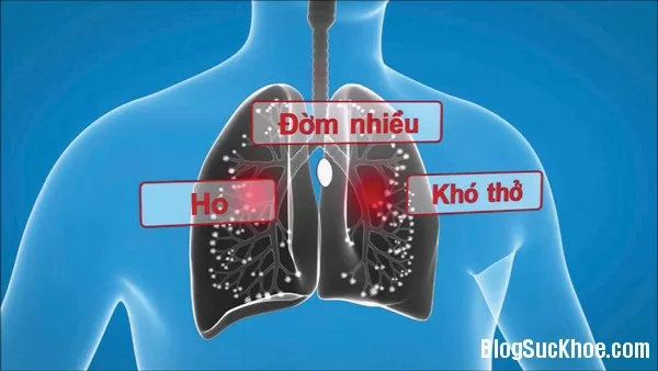 Phòng ngừa tái phát bệnh viêm phế quản mãn tính