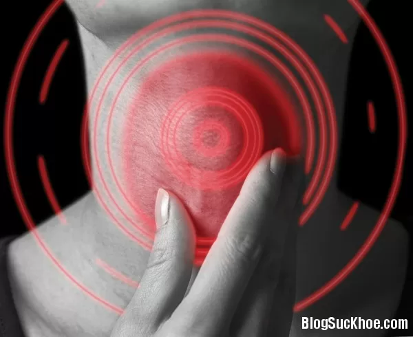 Nguyên nhân và triệu chứng bệnh polyp dây thanh quản
