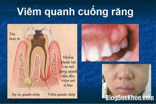 Thói quen xấu gây viêm quanh cuống răng