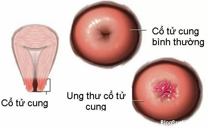 Ung thư cổ tử cung - căn bệnh gây tử vong hàng đầu cho phụ nữ