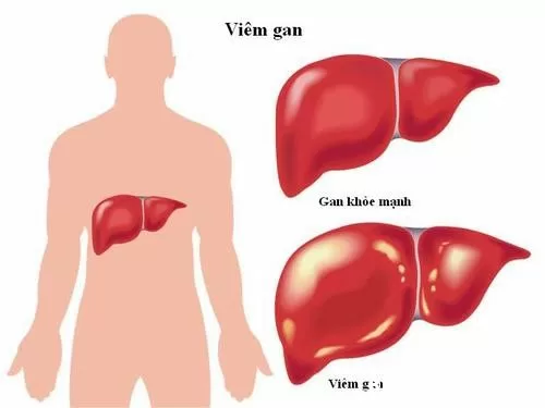 Tìm hiểu bệnh viêm gan E