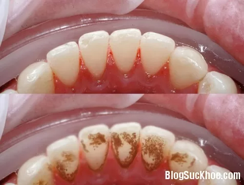 Bỏ túi bí quyết lấy cao răng tại nhà