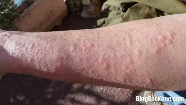 4 loại lá trị mề đay siêu hiệu quả