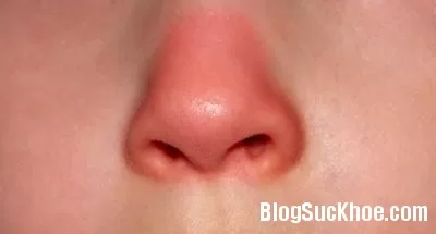 Mũi đỏ là bệnh gì? Trứng cá đỏ và các nguyên nhân cần phân biệt