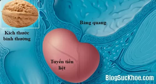 Tiên dược giúp ngăn ngừa ung thư tuyến tiền liệt