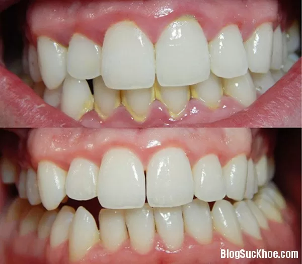 Chẳng cần đến nha sỹ bạn vẫn có hàm răng sáng đẹp tuyệt vời