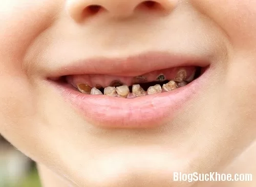 Bệnh sâu răng ở trẻ nhỏ
